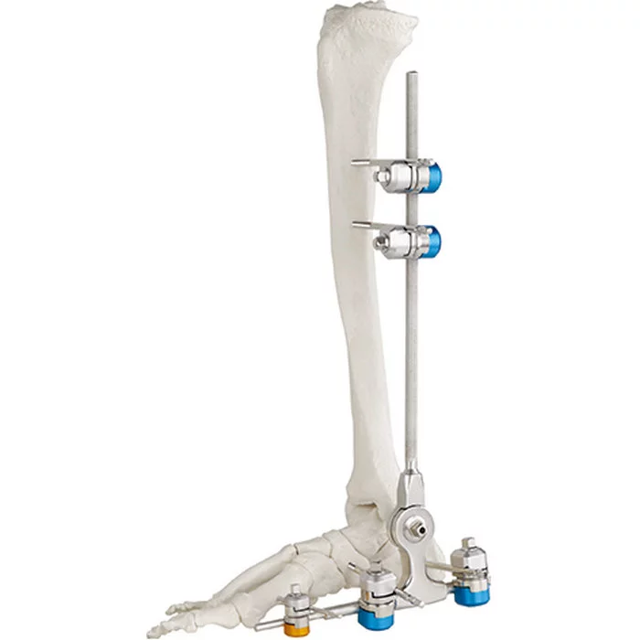 Instrumento externo ortopédico cirúrgico do osso dos instrumentos médicos de Fixator da junção de tornozelo do instrumento do martelo de alta qualidade do osso