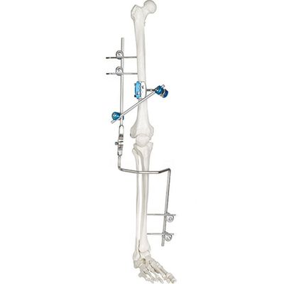 Instrumentos cirúrgicos ortopédicos externos médicos de dispositivo de fixação da articulação do joelho