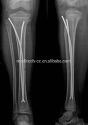 Prego elástico do titânio ortopédico dos implantes DEZ para a cirurgia das crianças